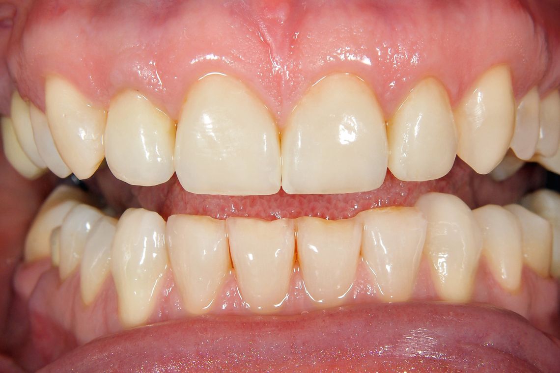 after composite bonding and whitening