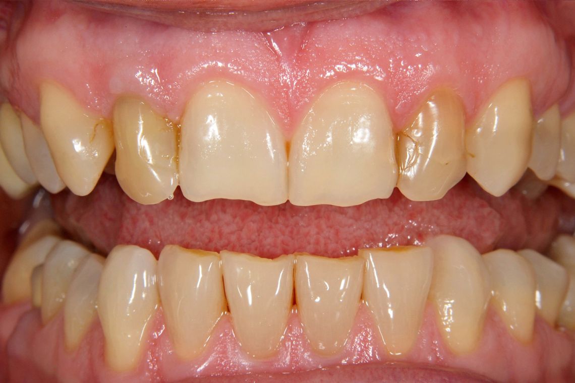 before composite bonding